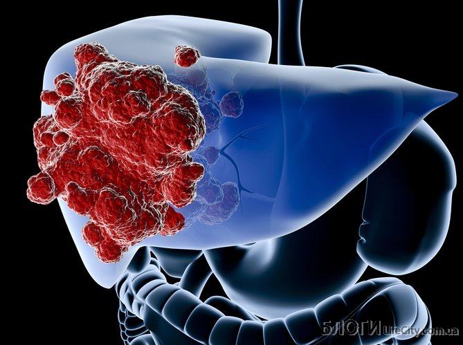Как связаны гепатит С и рак печени