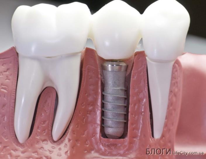 зубна імплантація