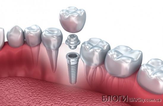 Імплантація зубів: питання та відповіді