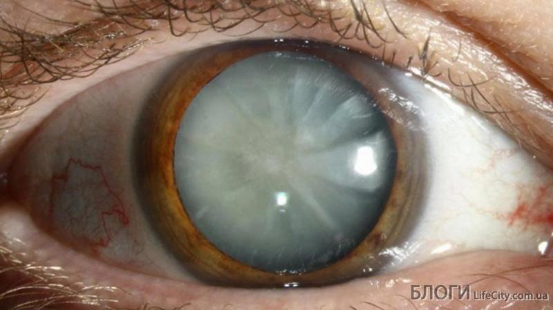 Вторинна катаракта