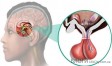 Аденома гипофиза. Что это и почему нельзя затягивать с лечением?